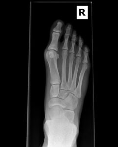 An x-ray image of a bunion before minimal incision surgery.